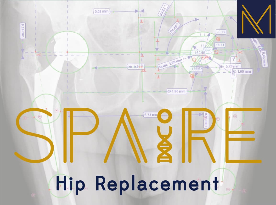 SPAIRE hip replacement technique