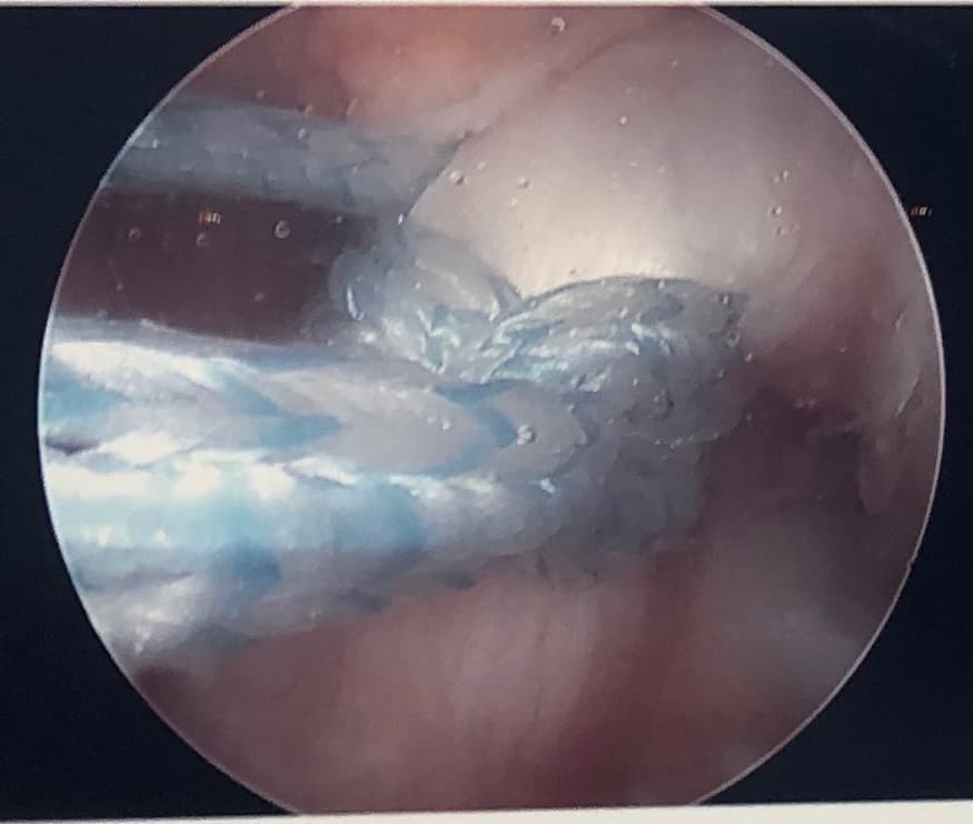 ACL repair surgical procedure
